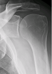 Anatomy of Shoulder
