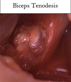 Biceps Tenodesis