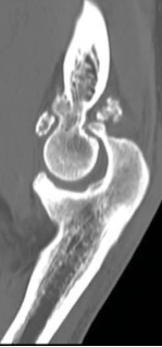 elbow osteoarthritis