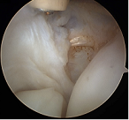 elbow arthroscopy