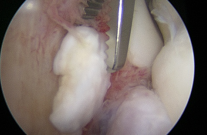 elbow arthroscopy