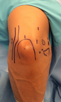 elbow arthroscopy