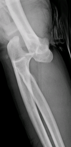 Elbow Dislocations