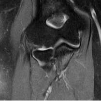 intact ligament