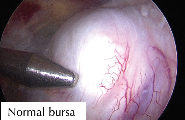 normal bursa