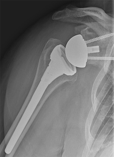 anatomy and function of shoulder