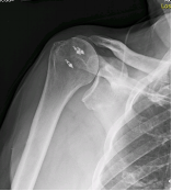 Rotator cuff damage