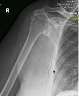 Rotator cuff tear arthropathy