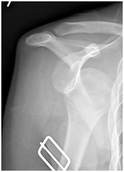 shoulder dislocation