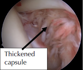 Thickened Capsule