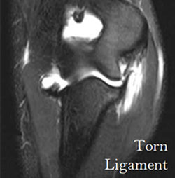 torn ligament