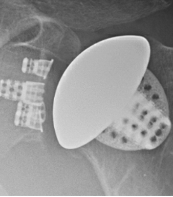 total shoulder replacement