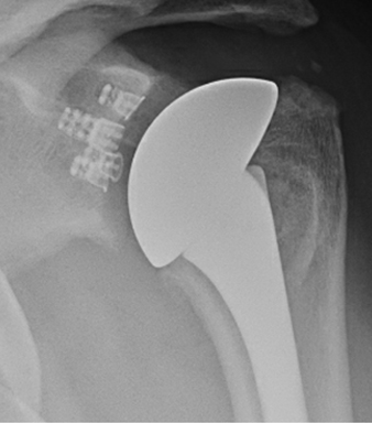 total shoulder replacement