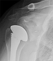 Total shoulder replacement
