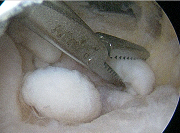 elbow osteoarthritis