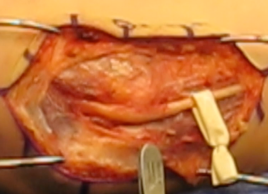 ulnar nerve treatment