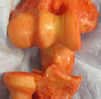 Elbow Arthritis