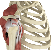 Shoulder Tendon Tears and Rotator Cuff Tears