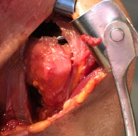 Shoulder Replacement Without Cutting Tendons